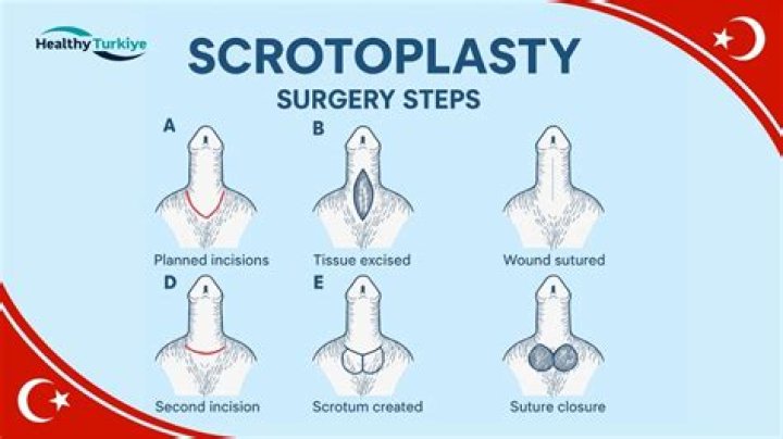 1.5 years after penis and scrotum transplant, injured veteran feels 'whole' again