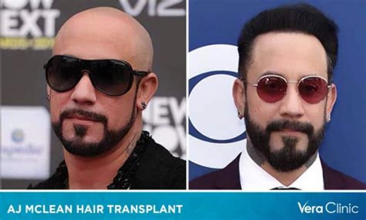 A.J. McLean Gets Hair Transplant: Backstreet Boys Singer Shares Before and After Pictures