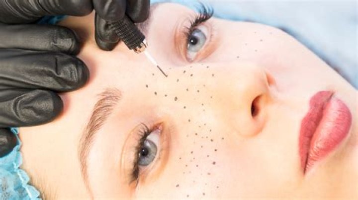 Beauty fan gets fake freckles tattooed ALL over her face… but trolls warn they'll 'age like a tramp stamp'