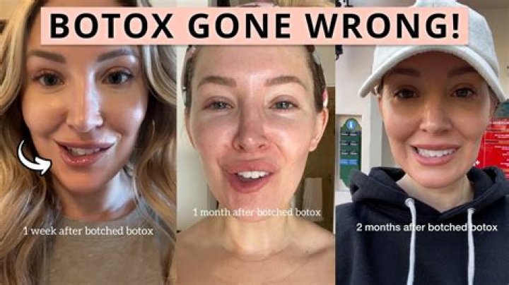 I got botched Botox - it's frozen my face and I can't move my chin, it's so bad, my husband’s terrified of me