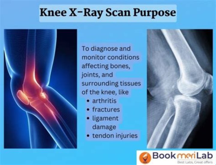 Question: Can Xray Be Done With Plaster