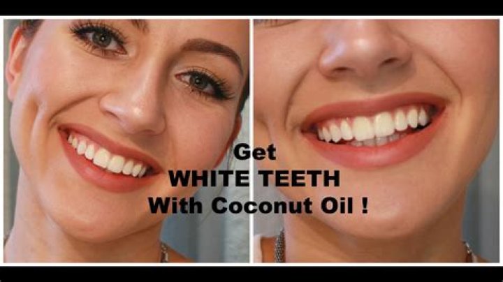 Coconut Oil For Teeth Whitening Review: Does It Work?