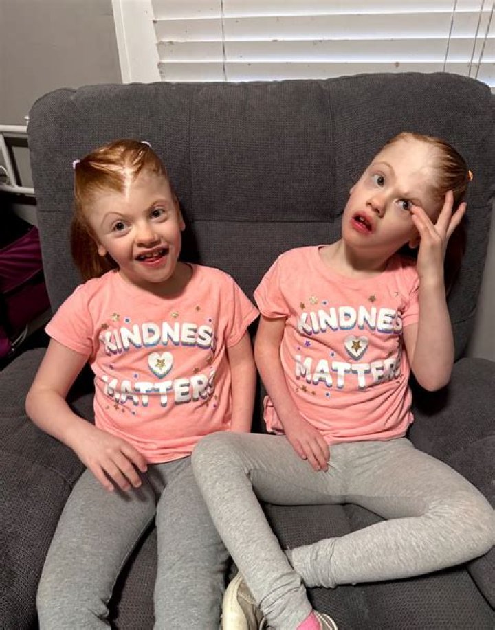 Conjoined twins Abby and Erin Delaney: Inside their remarkable story