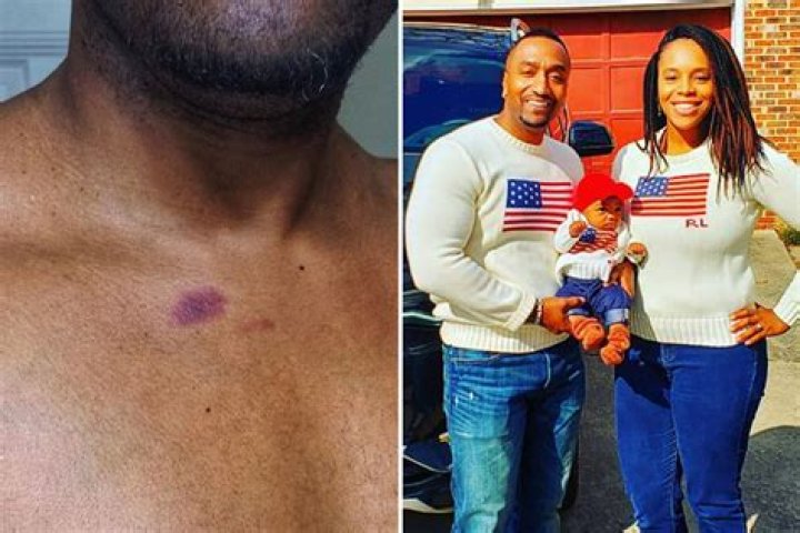 Dad shares the pain of breastfeeding after ‘blood-sucking Dracula’ daughter sucks his chest and leaves a massive bruise