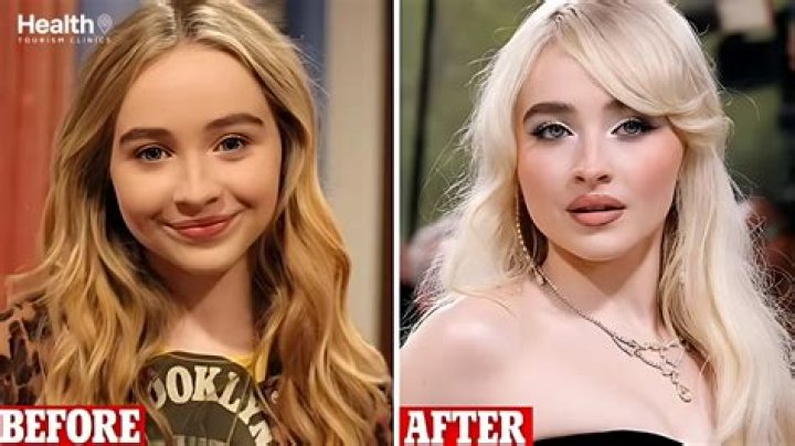 The Definitive Guide: Did Sabrina Carpenter Get Lip Fillers?