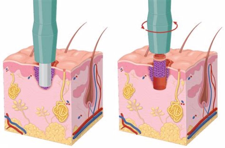 Does Aetna cover abdominoplasty?