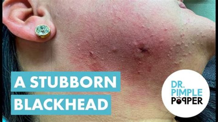 Dr Pimple Popper bursts huge ‘tick’ blackhead from patient’s ear in new video