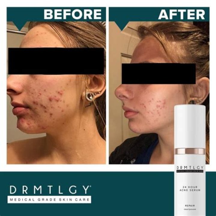 Drmtlgy Cystic Acne Treatment Is a Miracle for So Many Shoppers