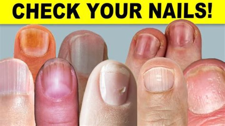 The 5 ways your NAILS can reveal if you’ve had Covid