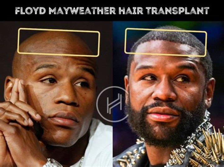 Floyd Mayweather shocks with new full head of hair with fans questioning if he's had transplant while showing off cars
