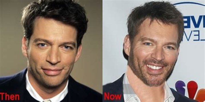 Understanding Harry Connick Jr.'s Facial Scar: A Deep Dive Into His Journey