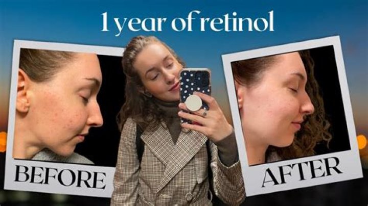 Question: How Long Does Retinol Last After Opening