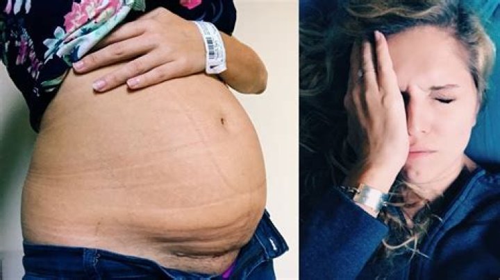 Question: How Long Does Surgical Glue Last After C Section