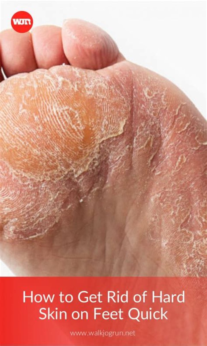 Remove Dry Skin On Your Feet With Our Expert Tips And Tricks