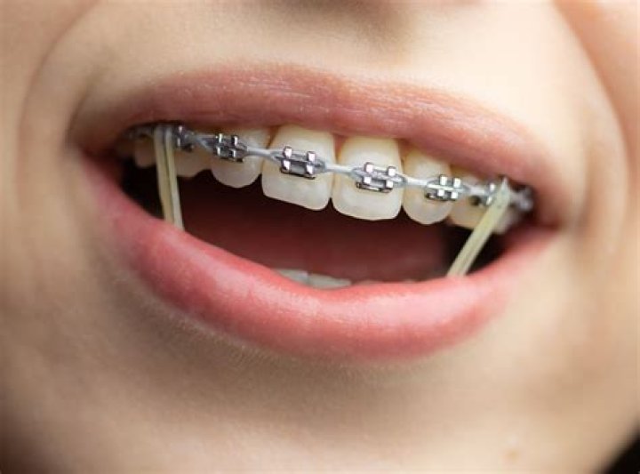Quick Answer: How To Make Diy Braces With Rubber Bands