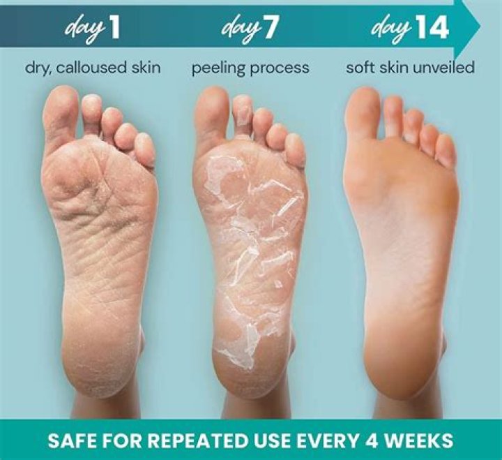 Quick Answer: How To Make Your Feet Peel