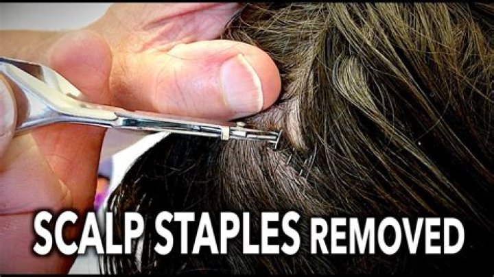 Quick Answer: How To Remove Staples From Head