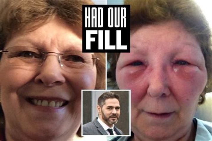 I was injected with BEEF gelatine ‘Botox’ by bogus doc and nearly died of anaphylactic shock – The US Sun