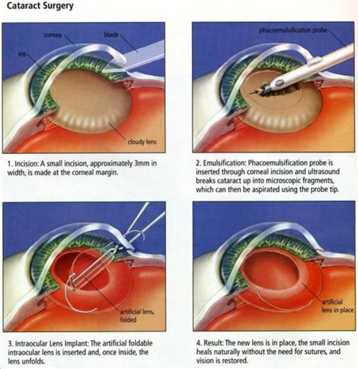Is fluttering normal after cataract surgery?
