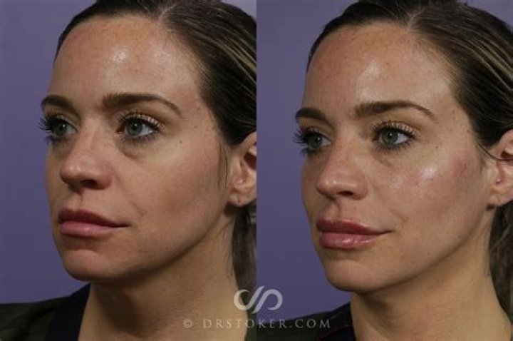 Kardashians' Doctor Says Cheek Fillers Are the New Face-Lift
