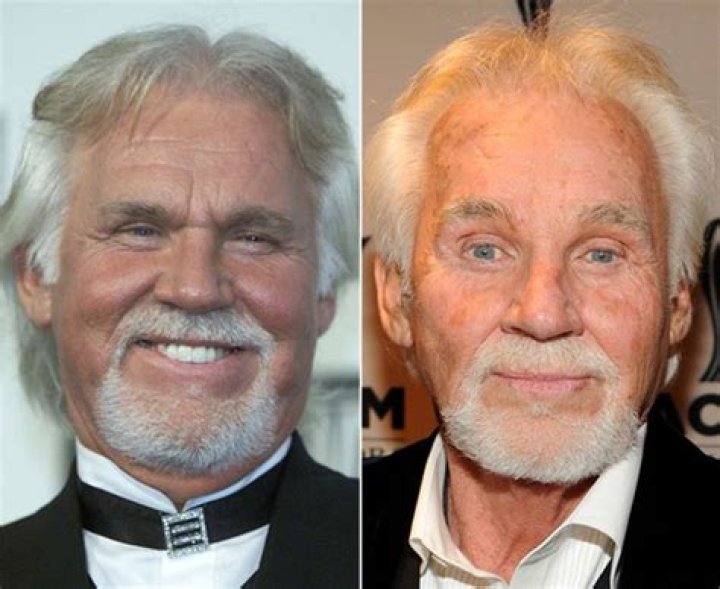 Kenny Rogers Plastic Surgery, Before and After