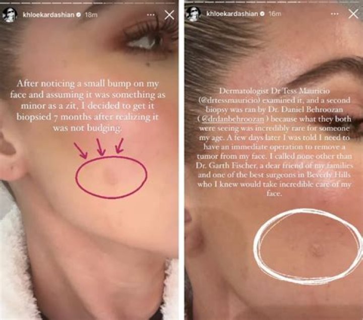 Khloe Kardashian Opens Up About Skin Cancer Scare