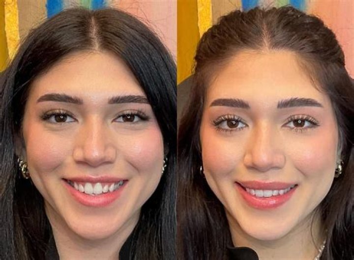 Lip Flip Before and After —Photos and Review 2023