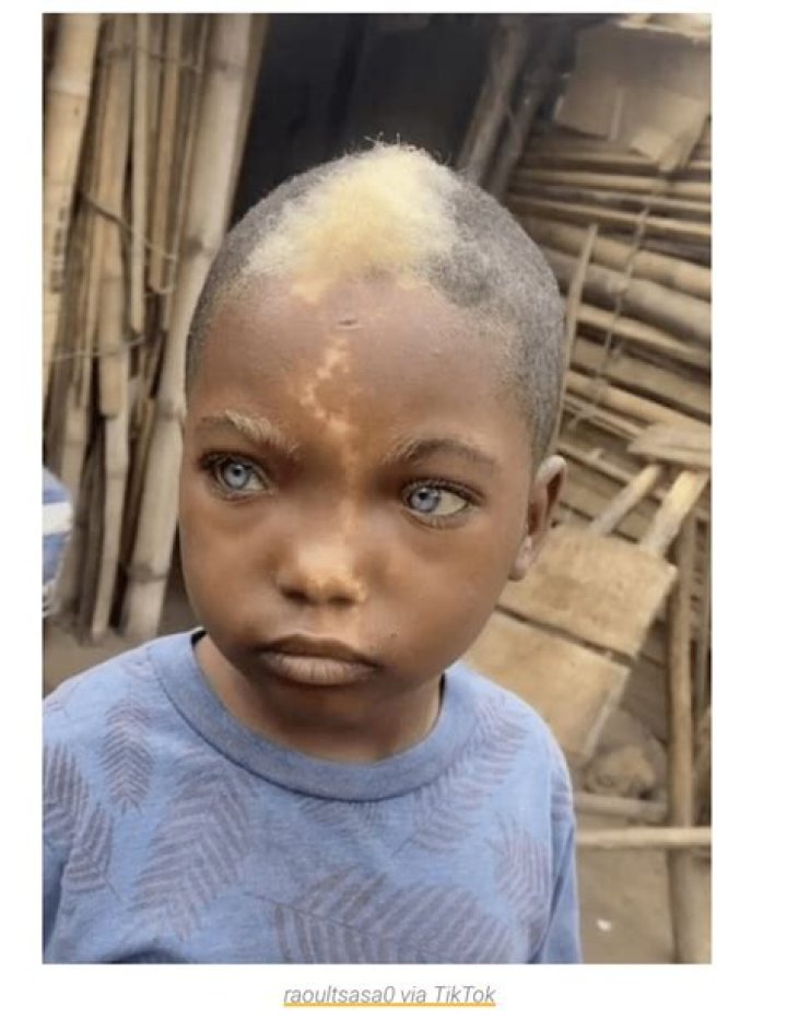 Little boy with natural blue eyes, white hairs and lightning mark down his face goes viral