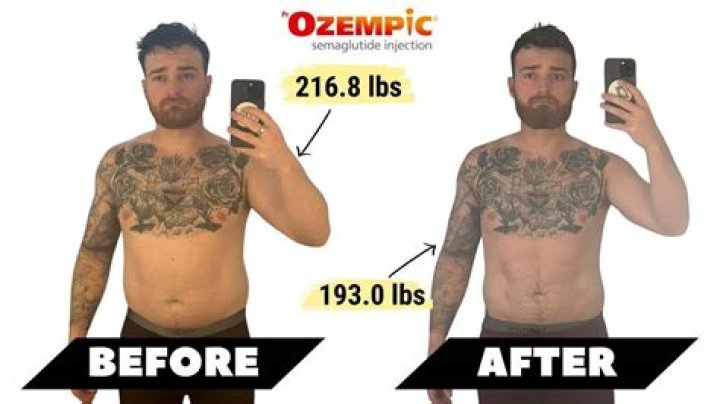I Lost 147 Pounds After Taking Ozempic