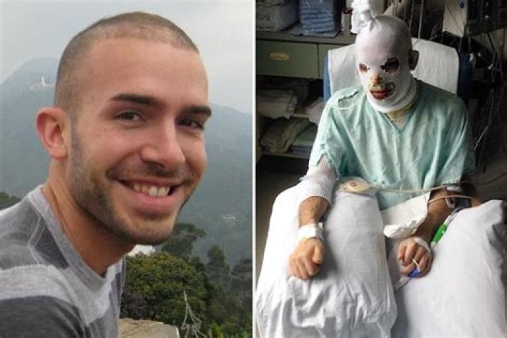 Man had eyes stitched shut and body covered in pig skin after rare reaction left him ‘burning from the inside out’ – The US Sun
