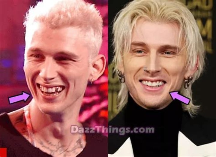 Unveiling The Mystery Of MGK's Teeth: What You Need To Know