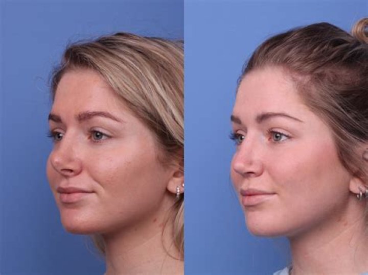 Did They Have a Nose Job?