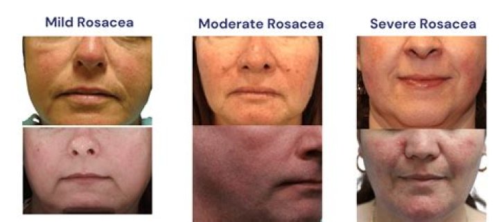 How To Treat Rosacea: What I've Learned From 5 Years With The Condition