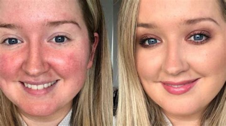 Rose Gallagher Shares Her Best Rosacea Product Recommendations