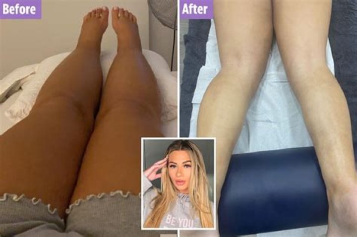 Shaughna Phillips shares liposuction surgery before and after pics and says 'have you ever seen legs that swollen?'
