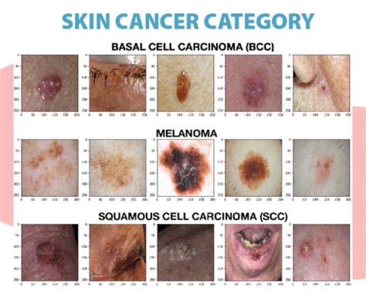 I’m a mole specialist - these are the skin cancer signs I’m looking for
