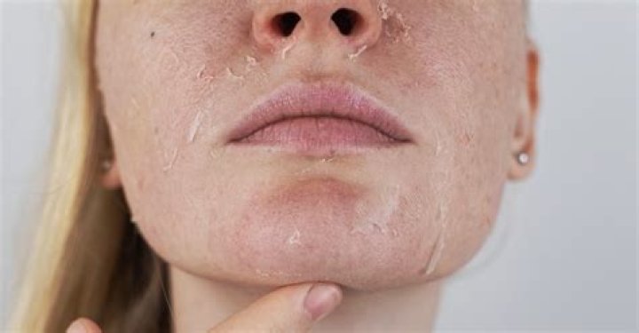 Skin Peeling During Pregnancy: Why It Happens & How To Treat It