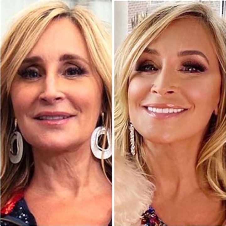 Exploring Sonja Morgan's Face Lift Journey