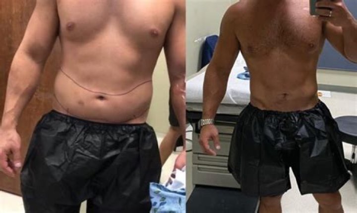 Unmasking The Sono Bello Nightmare: A Journey Through Transformation And Controversy