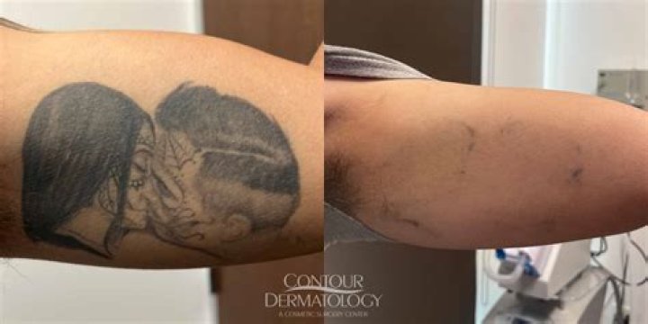 11 things you need to know about tattoo removal