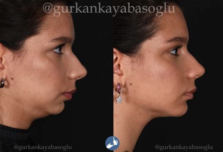 I flew to Turkey & splashed £5.7k on a mega makeover…trolls call me fake & say I could’ve died, but I didn’t so it's ok