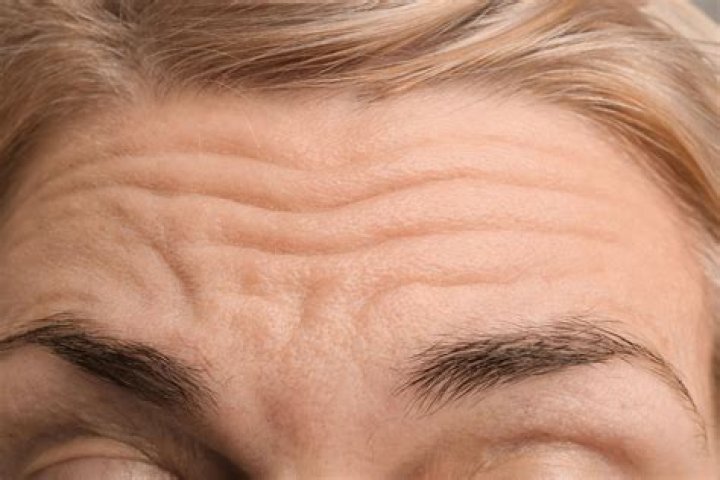 What Do Forehead Wrinkles Mean? Possibly Bad Sign for Heart Health