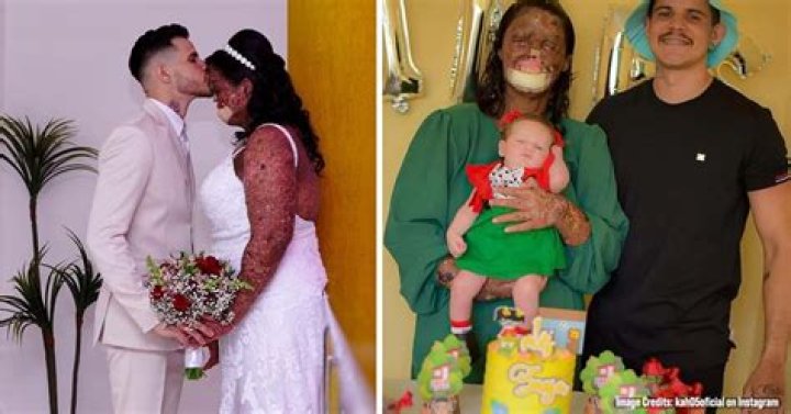 Woman with rare skin condition overcomes negativity and finds true love